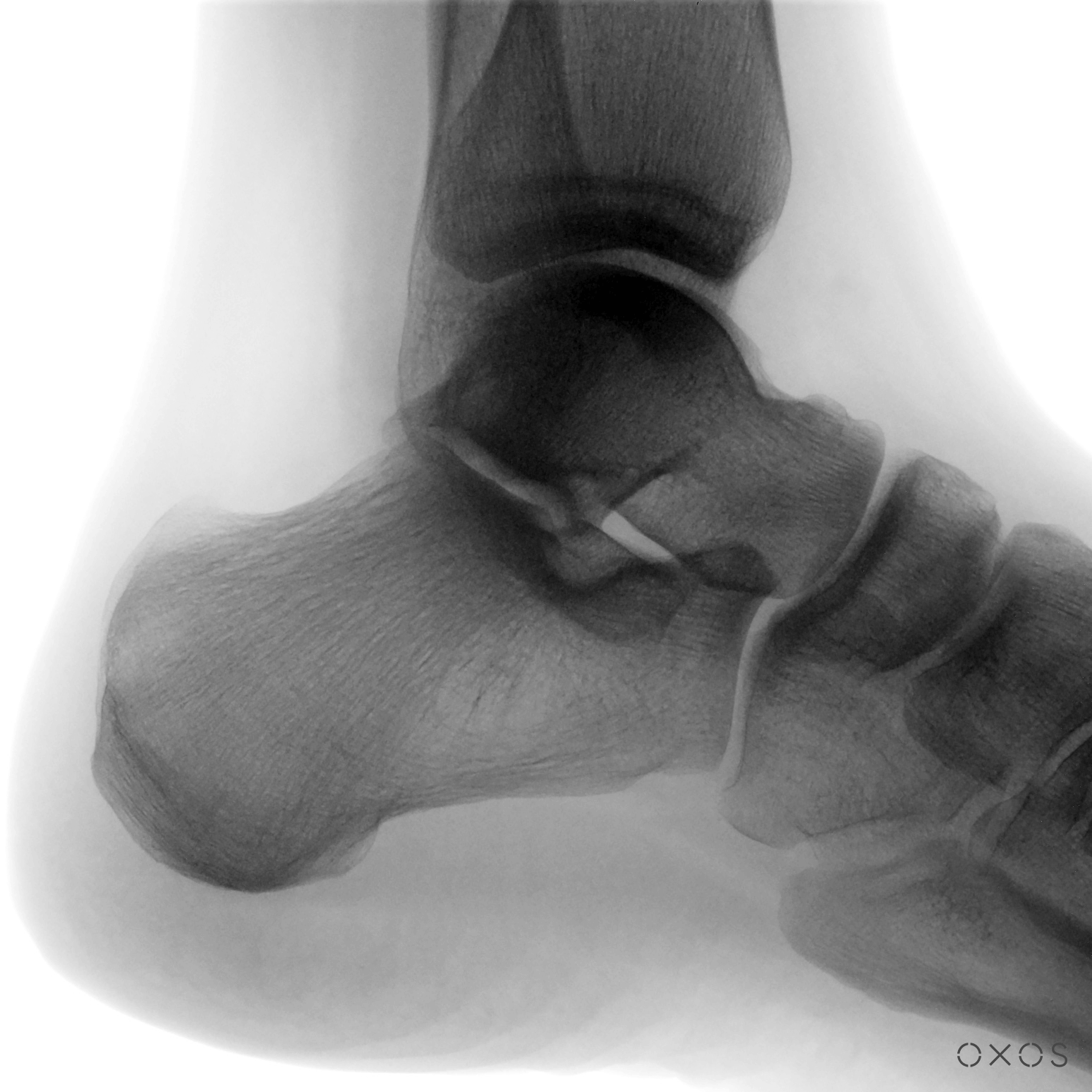 Ankle, Lateral, 13.7 µGy