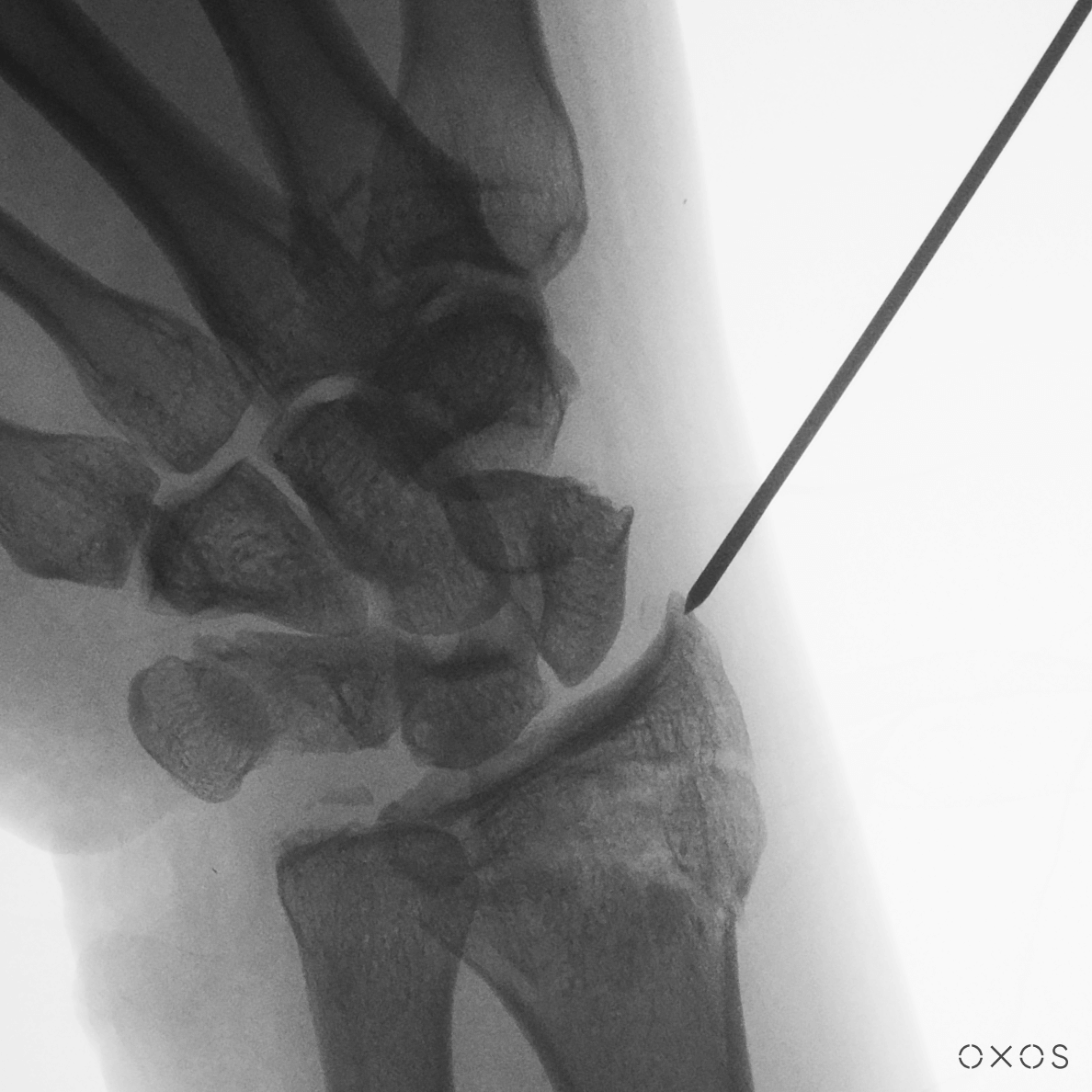 Image of percutaneous pinning of Wrist fracture Using Micro C, 9.7 µGy