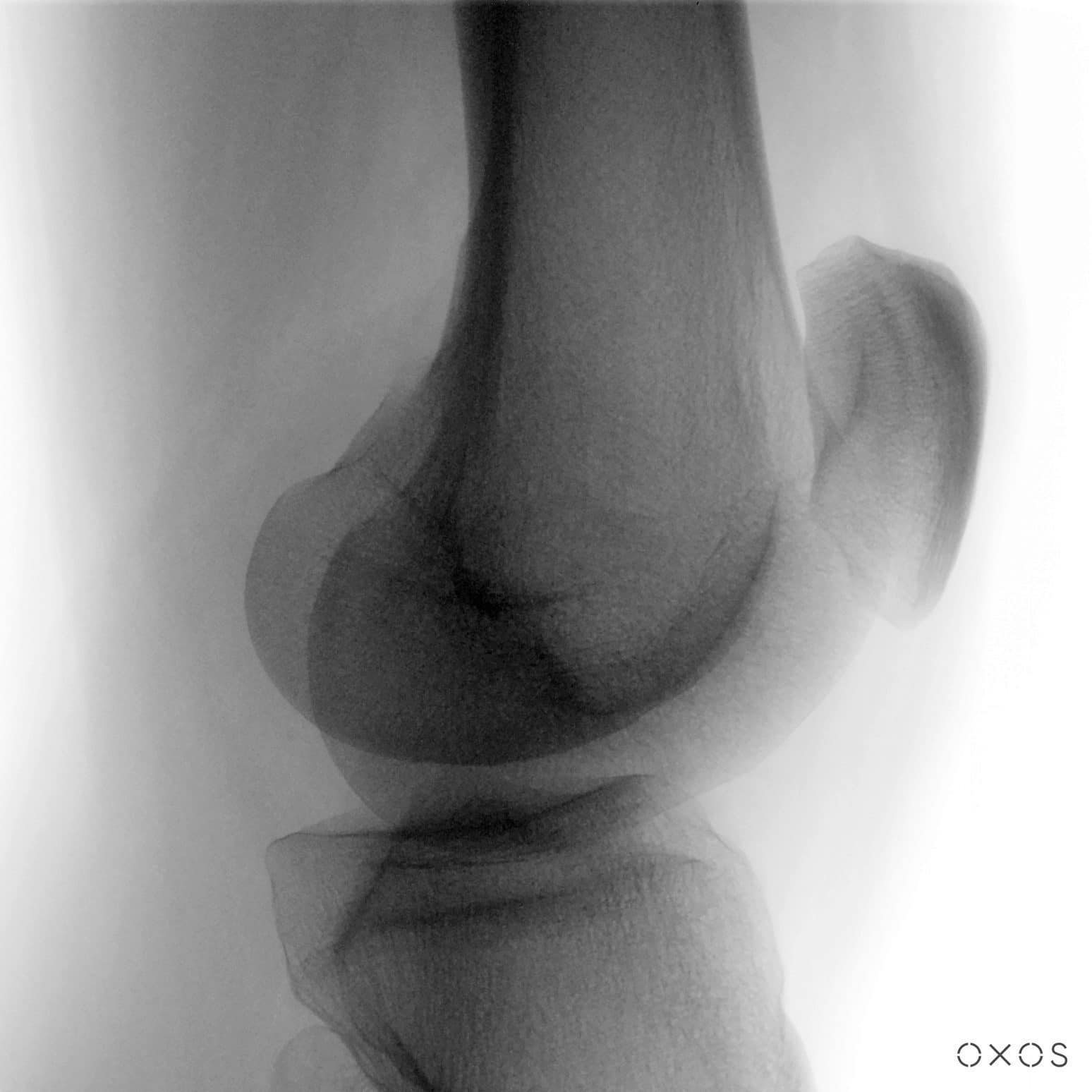 Knee Lateral, 23.4 µGy