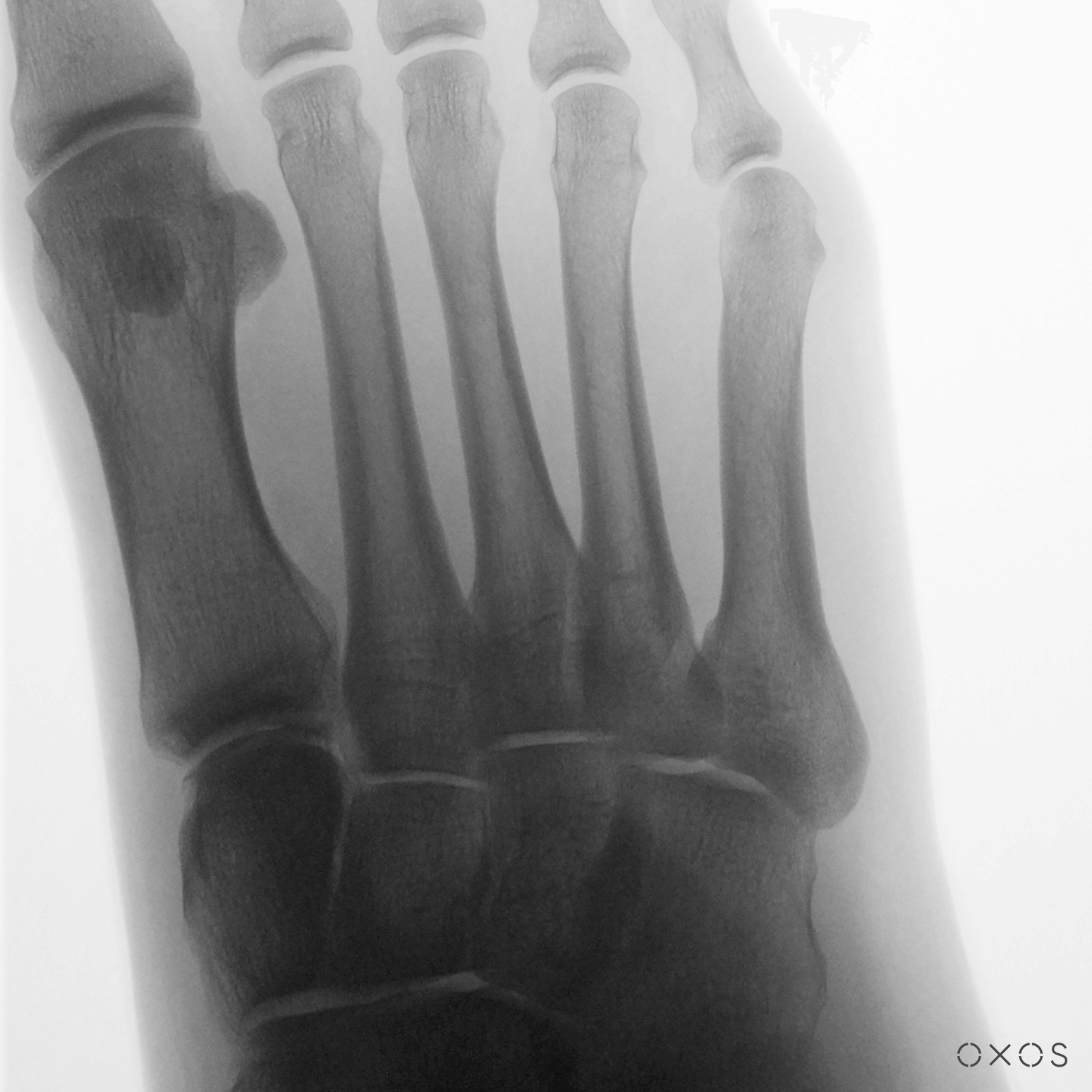 Foot, Oblique, 4.8 µGy