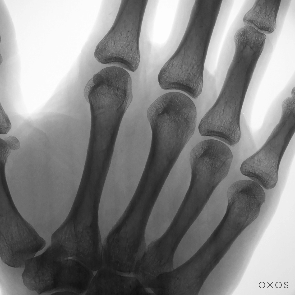 X-ray of Hand Using Micro C