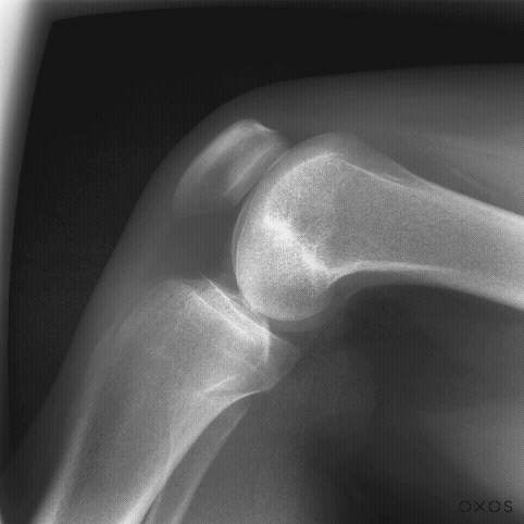 Knee DDR Gif dynamic digital radiography capture of the knee in motion.